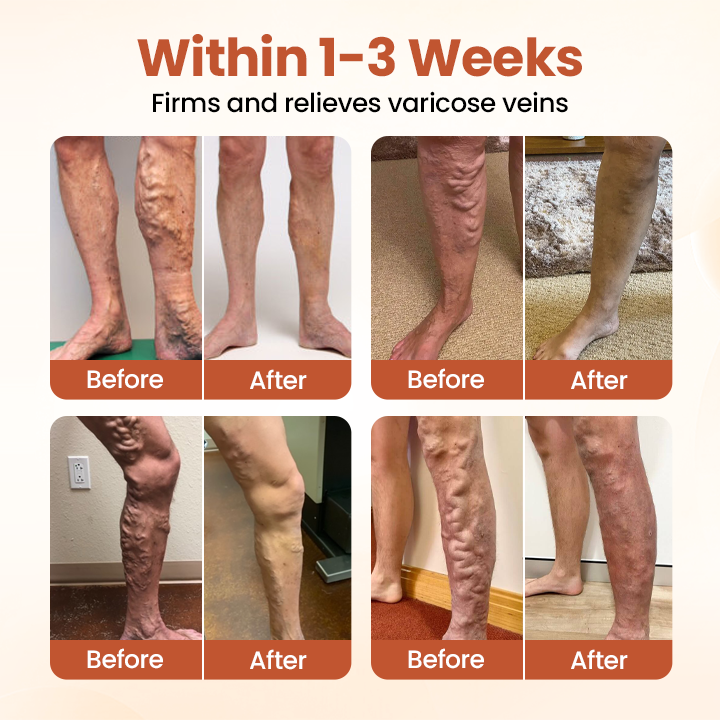 US🧑‍⚕️TAILEDEN®VeinTarget Microneedle Patch⚡Instant Relief, Long-Term Results