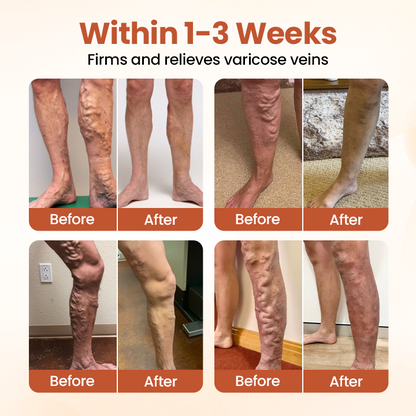 US🧑‍⚕️TAILEDEN®VeinTarget Microneedle Patch⚡Instant Relief, Long-Term Results